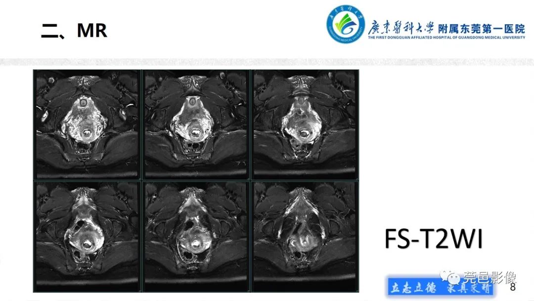 【病例】不全流产1例超声及MR影像-8