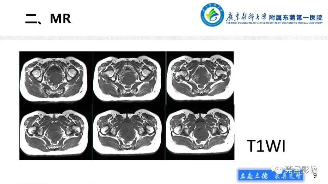 【病例】不全流产1例超声及MR影像-9