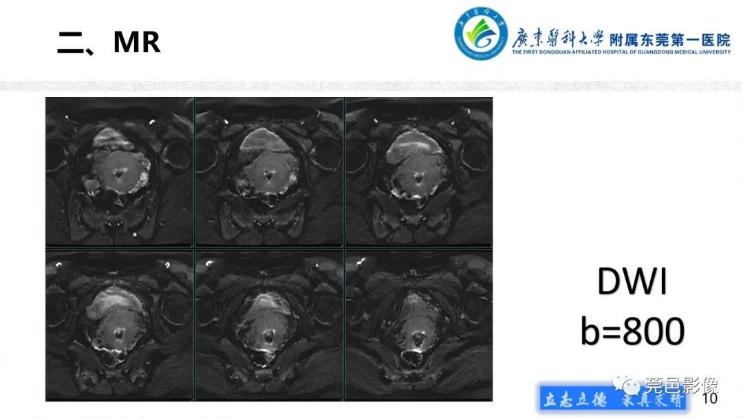 【病例】不全流产1例超声及MR影像-10
