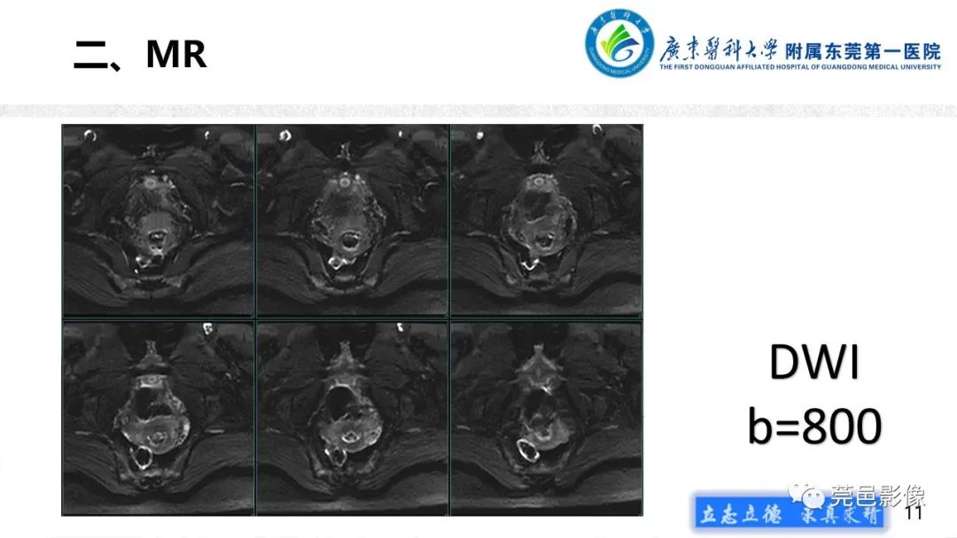 【病例】不全流产1例超声及MR影像-11