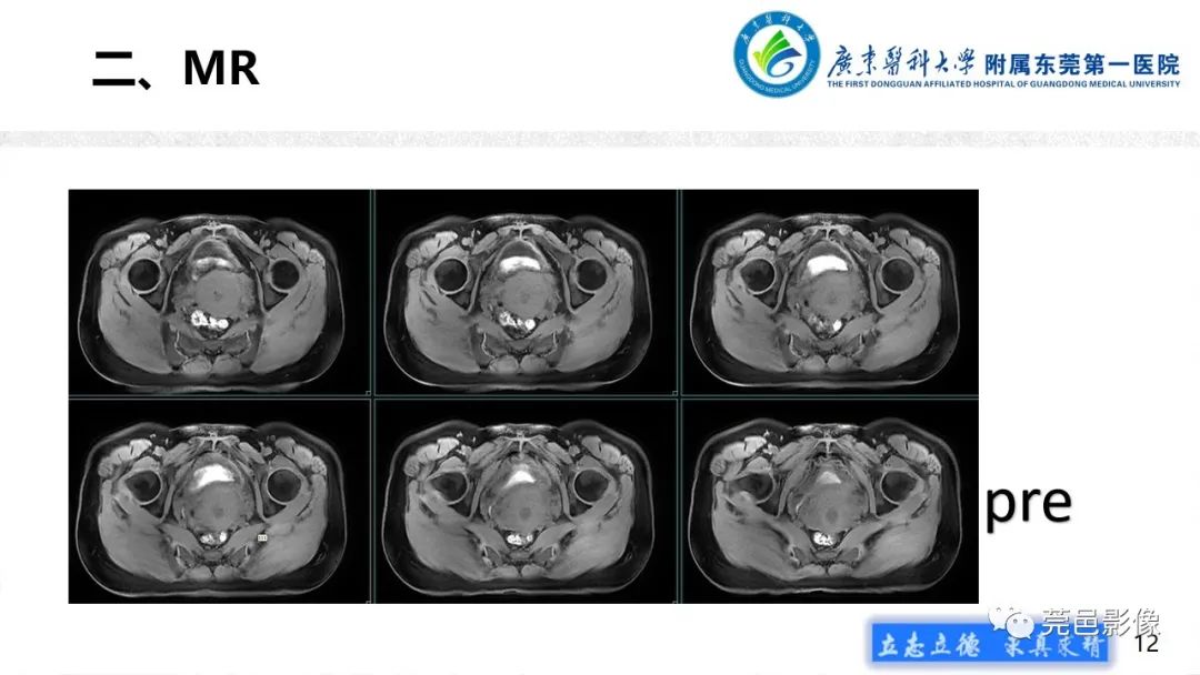 【病例】不全流产1例超声及MR影像-12