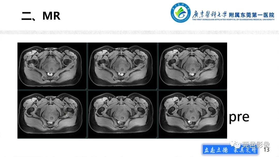 【病例】不全流产1例超声及MR影像-13