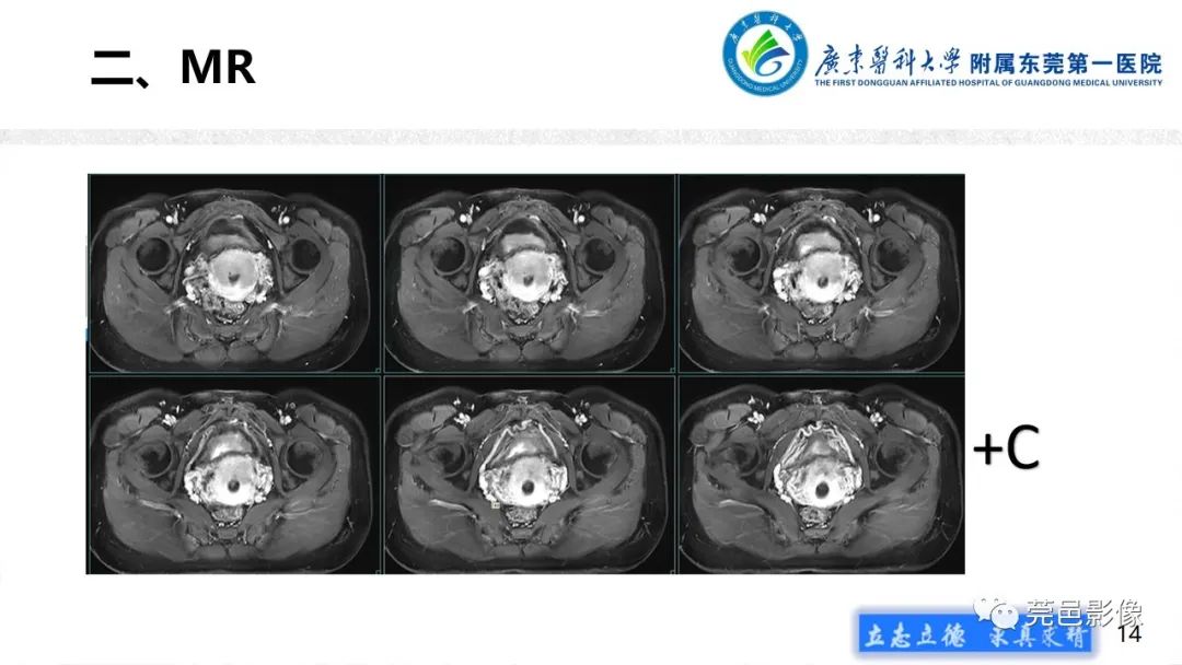 【病例】不全流产1例超声及MR影像-14