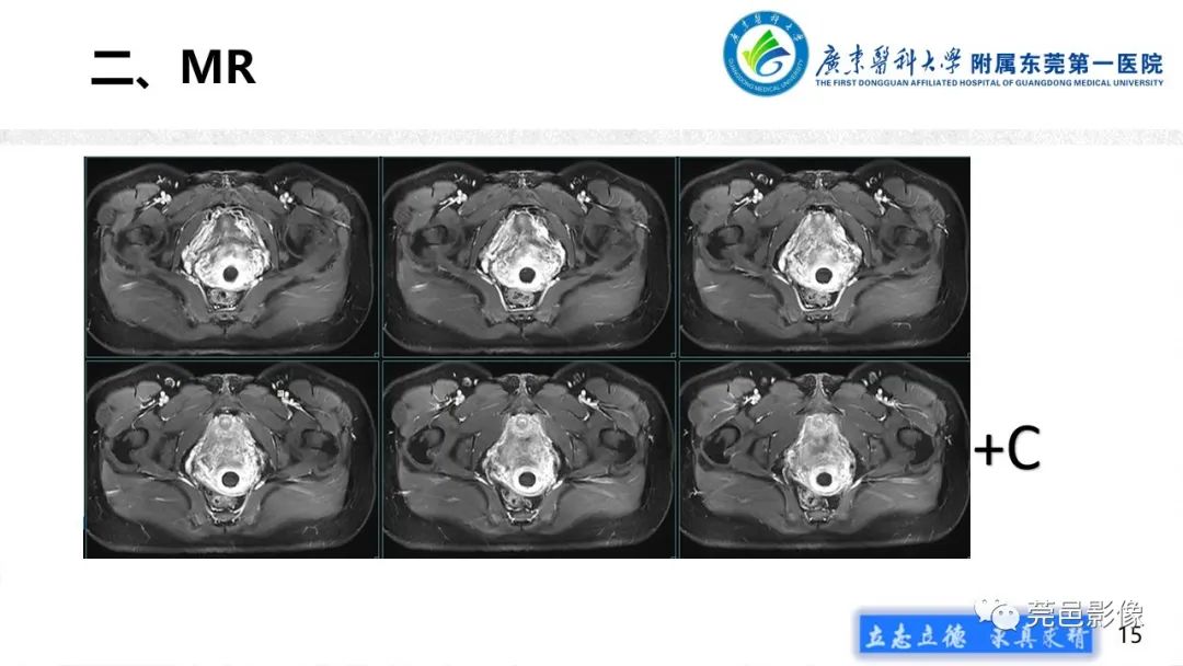 【病例】不全流产1例超声及MR影像-15