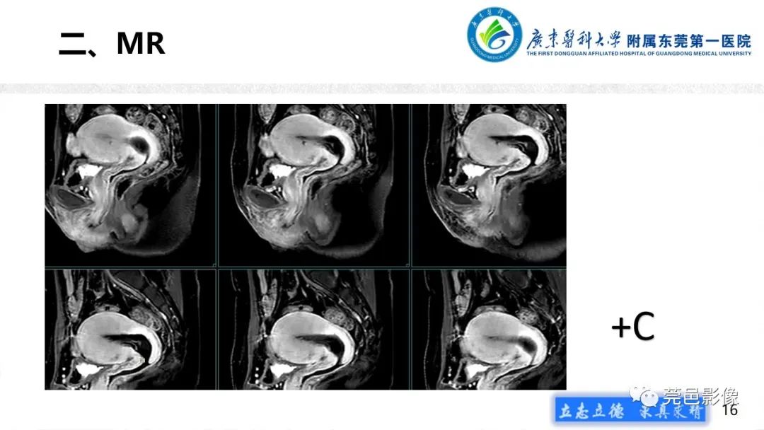 【病例】不全流产1例超声及MR影像-16