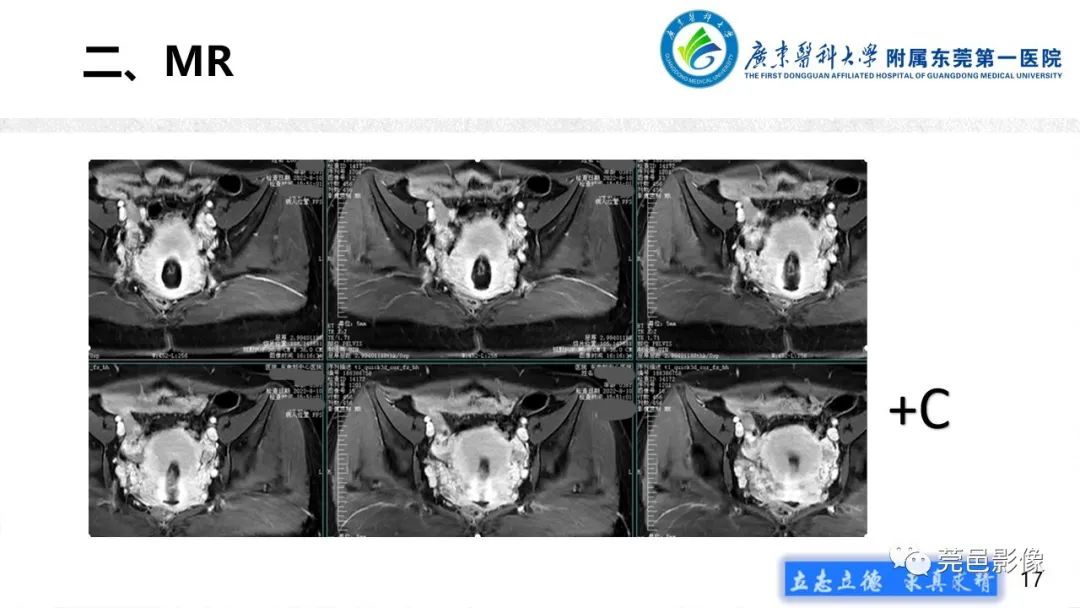 【病例】不全流产1例超声及MR影像-17