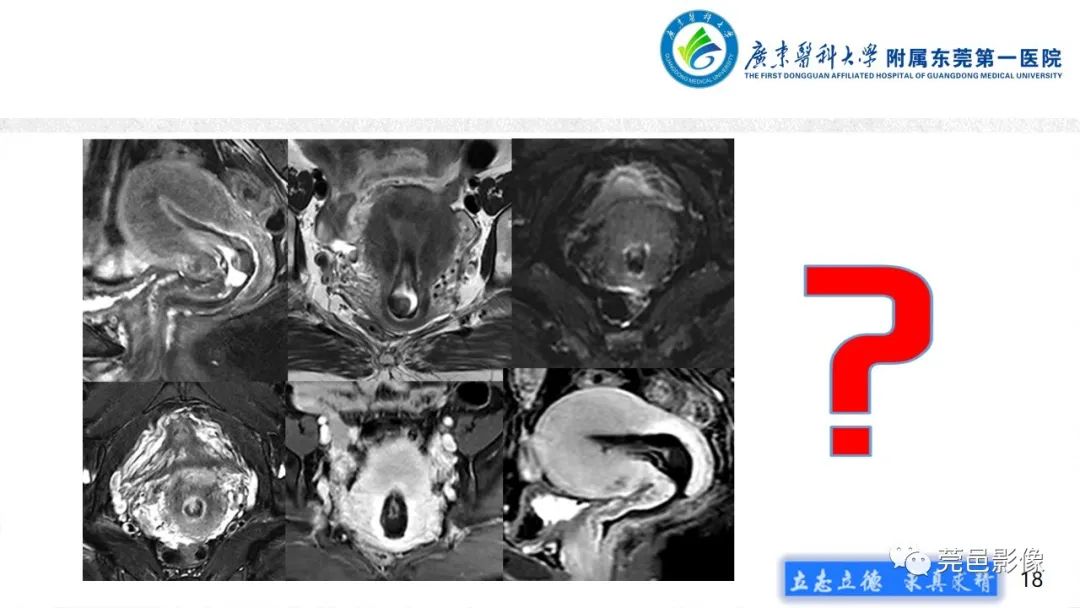 【病例】不全流产1例超声及MR影像-18