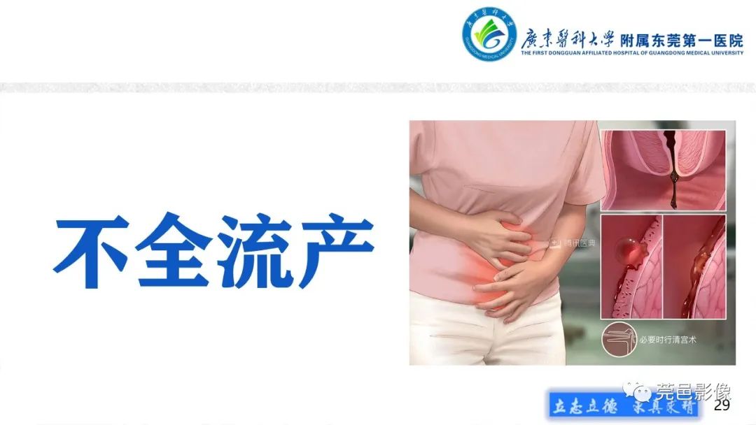 【病例】不全流产1例超声及MR影像-29