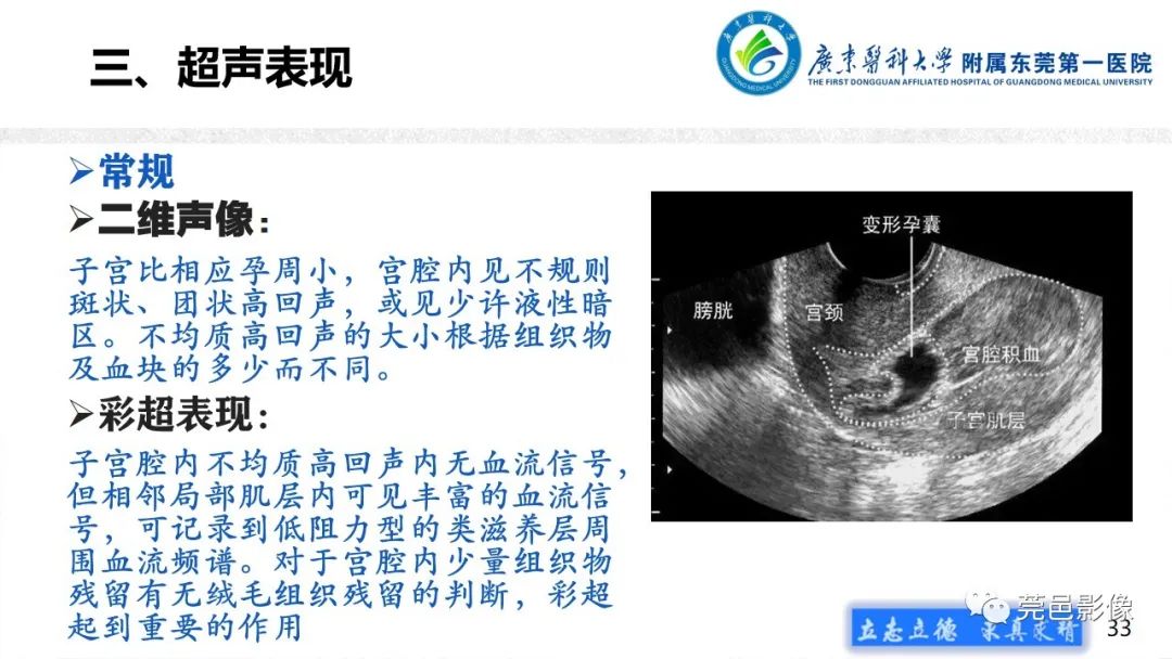 【病例】不全流产1例超声及MR影像-33