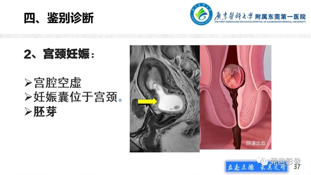 【病例】不全流产1例超声及MR影像-37