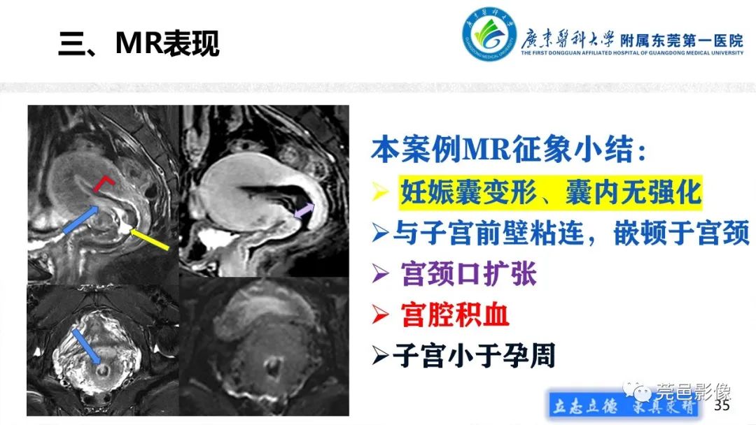 【病例】不全流产1例超声及MR影像-35