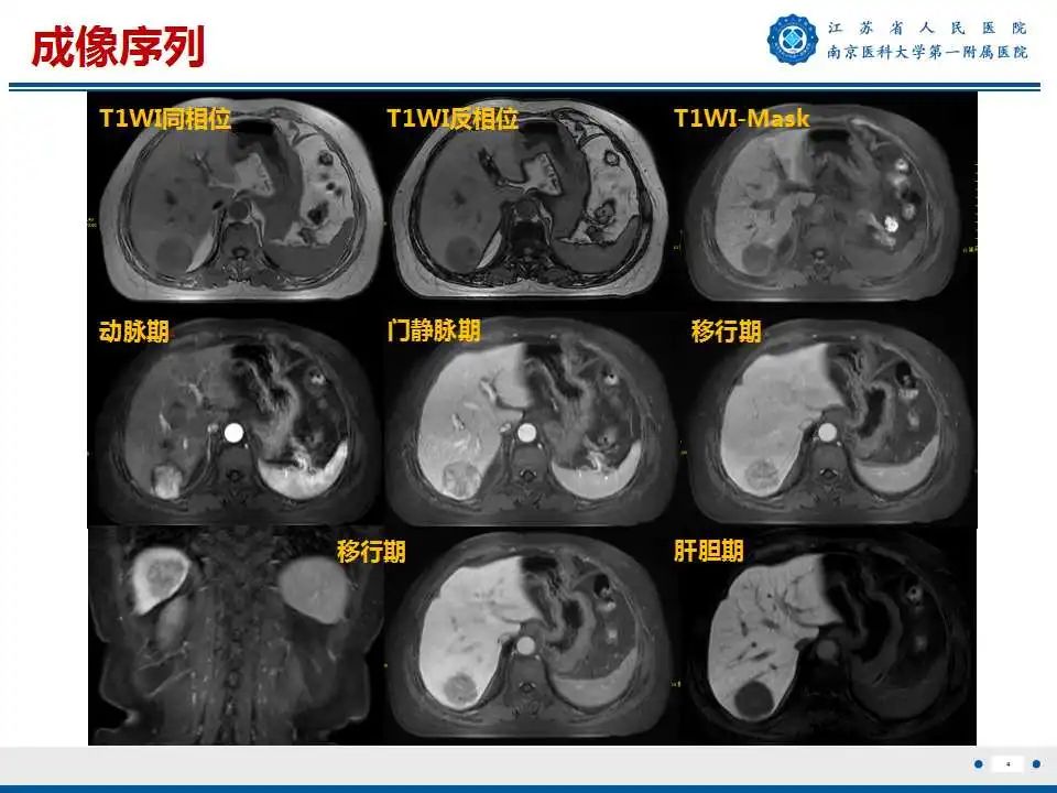 【PPT】肝细胞癌—肝脏肿瘤术前MR评估-5