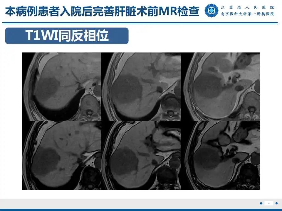 【PPT】肝细胞癌—肝脏肿瘤术前MR评估-7