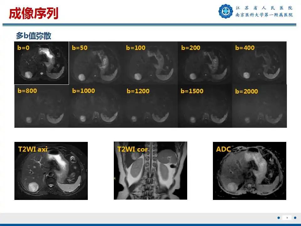 【PPT】肝细胞癌—肝脏肿瘤术前MR评估-6