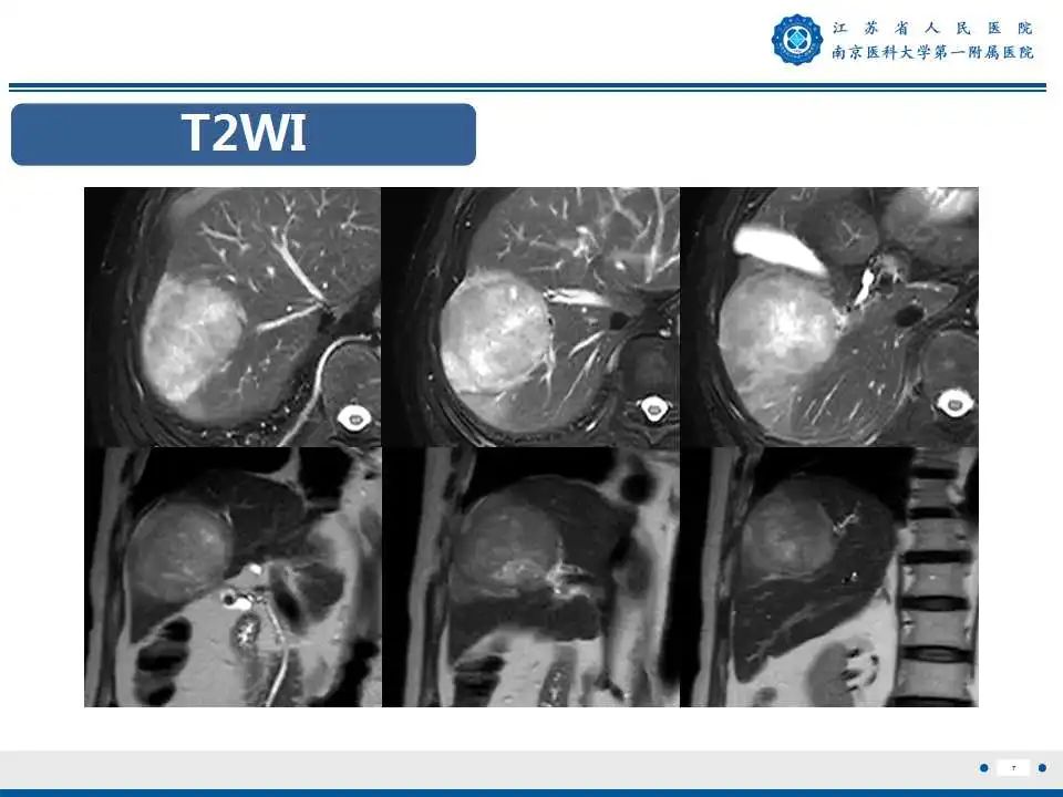 【PPT】肝细胞癌—肝脏肿瘤术前MR评估-8