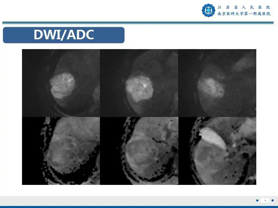 【PPT】肝细胞癌—肝脏肿瘤术前MR评估-9