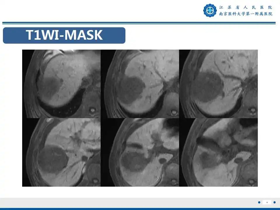 【PPT】肝细胞癌—肝脏肿瘤术前MR评估-10
