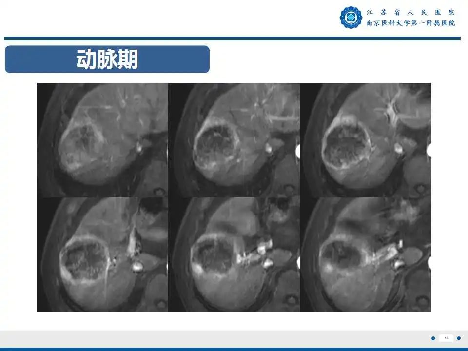 【PPT】肝细胞癌—肝脏肿瘤术前MR评估-11