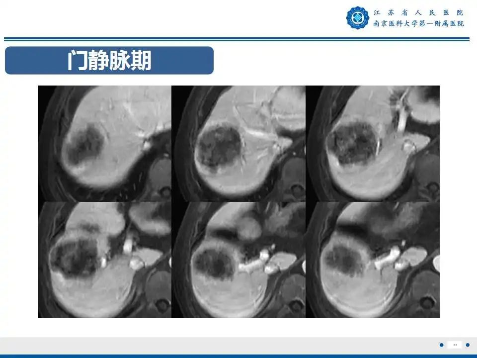 【PPT】肝细胞癌—肝脏肿瘤术前MR评估-12