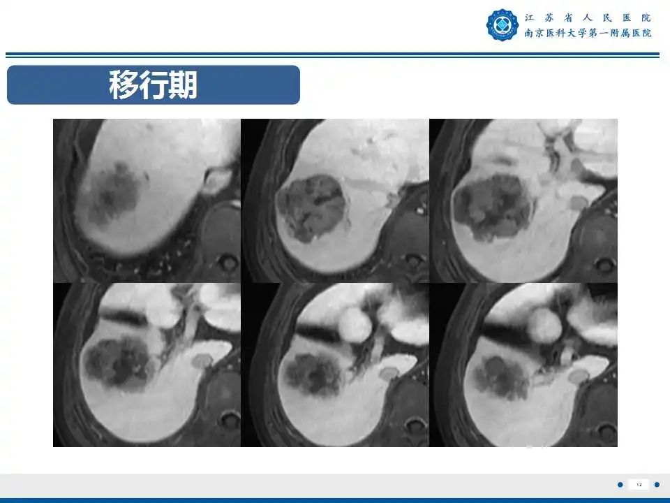 【PPT】肝细胞癌—肝脏肿瘤术前MR评估-13