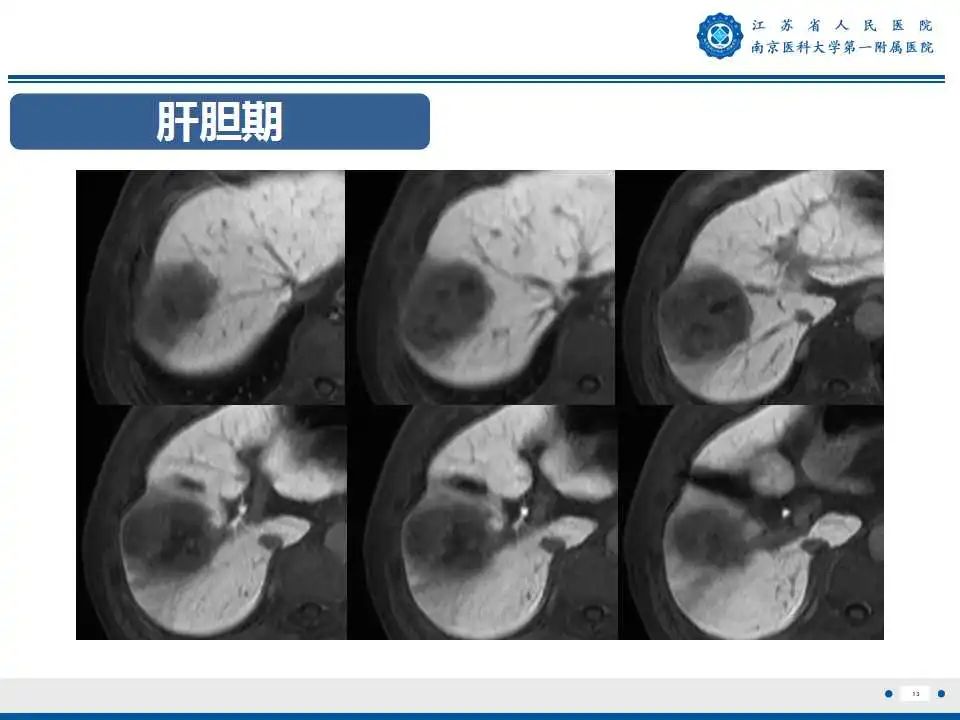 【PPT】肝细胞癌—肝脏肿瘤术前MR评估-14