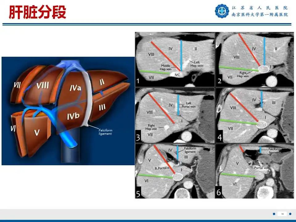 【PPT】肝细胞癌—肝脏肿瘤术前MR评估-17
