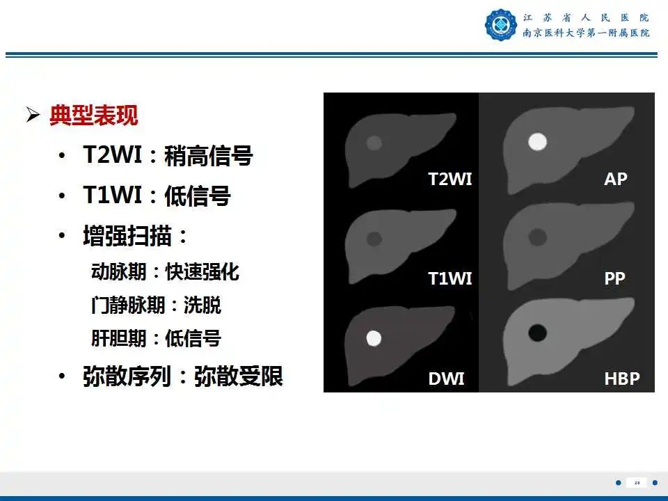 【PPT】肝细胞癌—肝脏肿瘤术前MR评估-29
