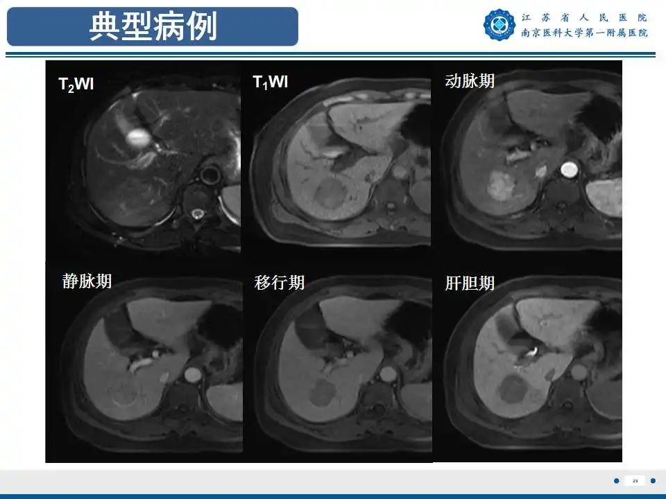 【PPT】肝细胞癌—肝脏肿瘤术前MR评估-30