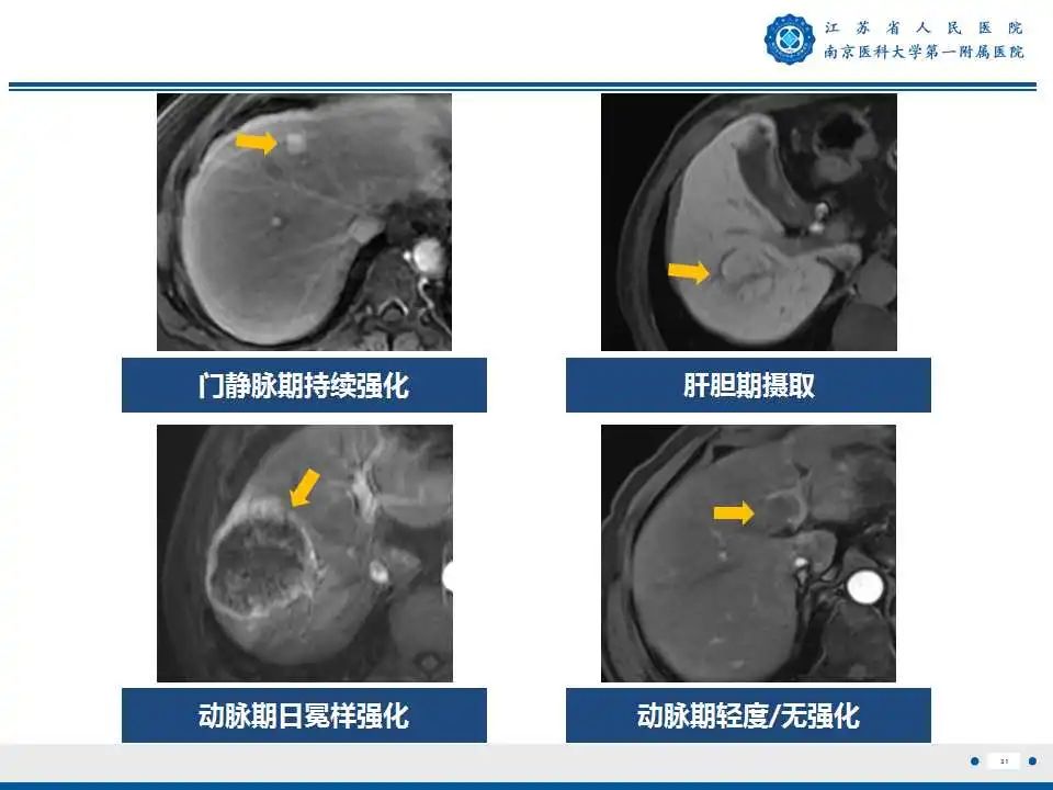 【PPT】肝细胞癌—肝脏肿瘤术前MR评估-32
