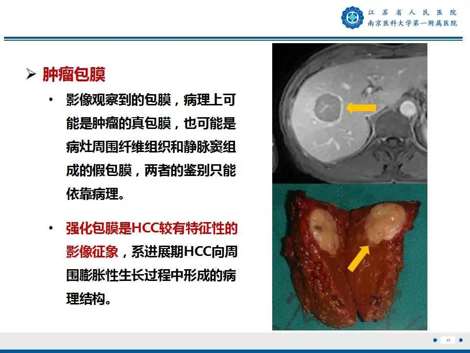 【PPT】肝细胞癌—肝脏肿瘤术前MR评估-34