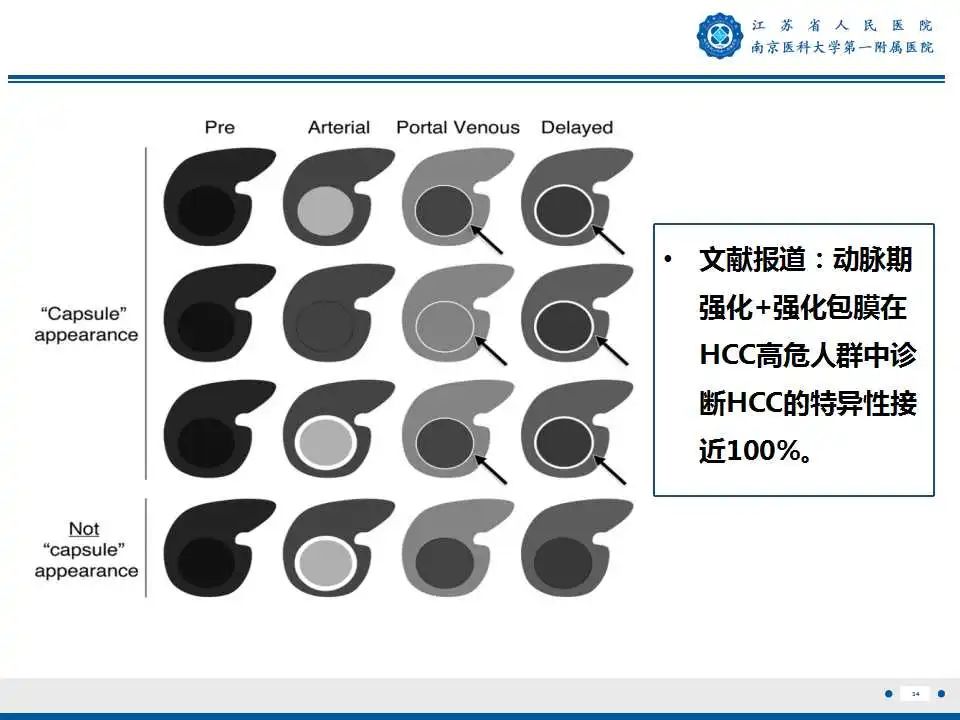 【PPT】肝细胞癌—肝脏肿瘤术前MR评估-35