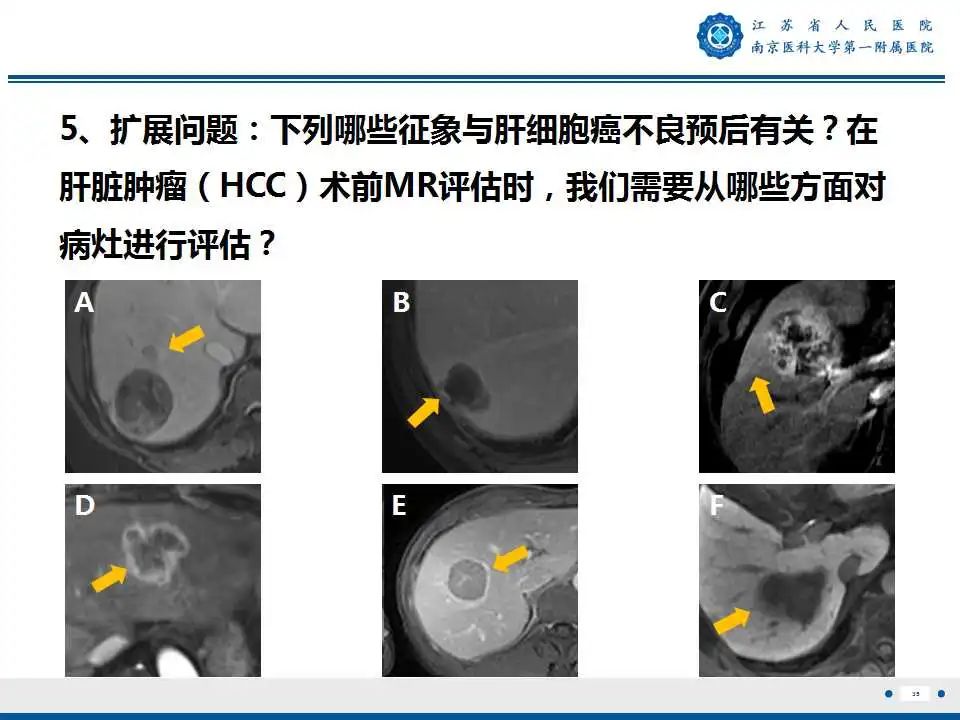 【PPT】肝细胞癌—肝脏肿瘤术前MR评估-36