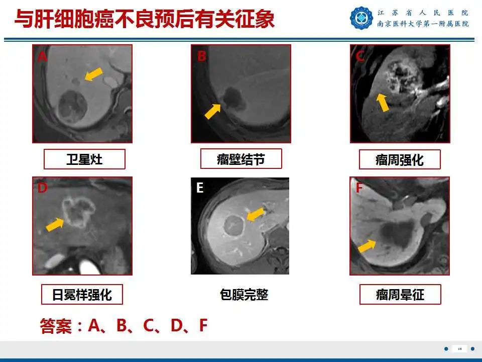 【PPT】肝细胞癌—肝脏肿瘤术前MR评估-37