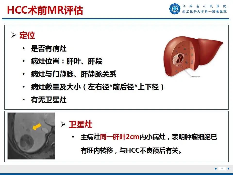 【PPT】肝细胞癌—肝脏肿瘤术前MR评估-38