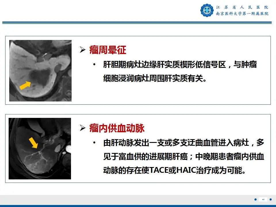 【PPT】肝细胞癌—肝脏肿瘤术前MR评估-41