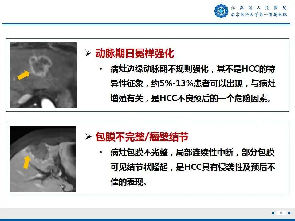 【PPT】肝细胞癌—肝脏肿瘤术前MR评估-40