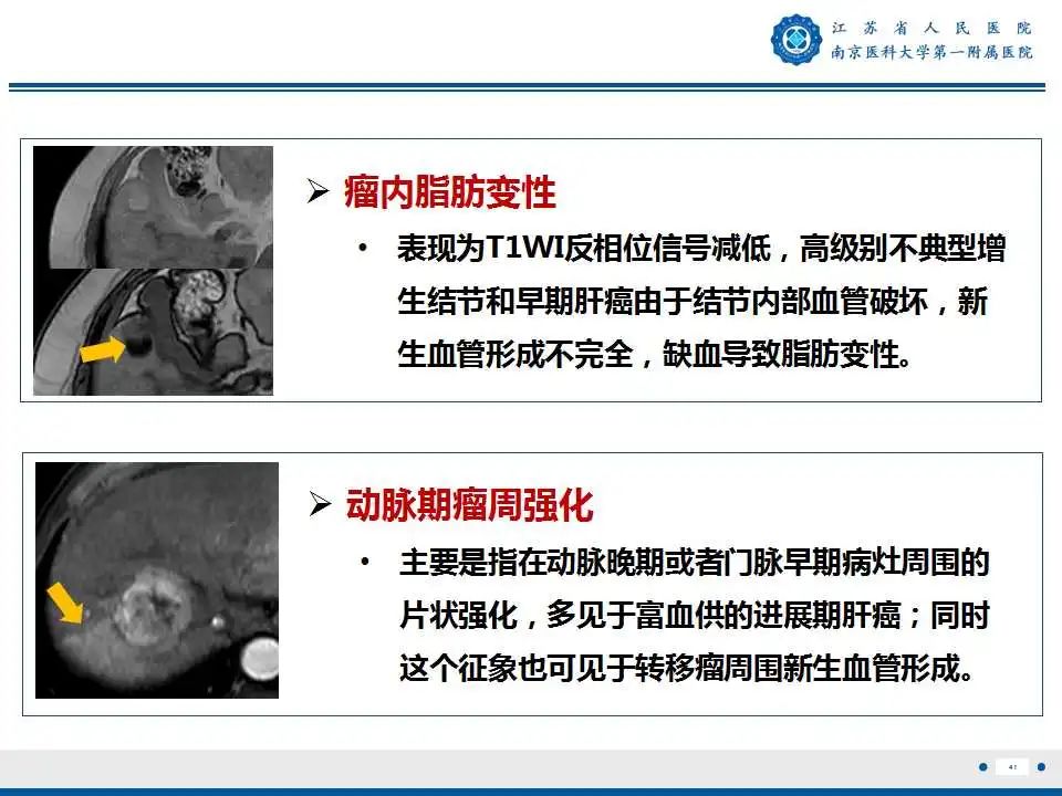【PPT】肝细胞癌—肝脏肿瘤术前MR评估-42