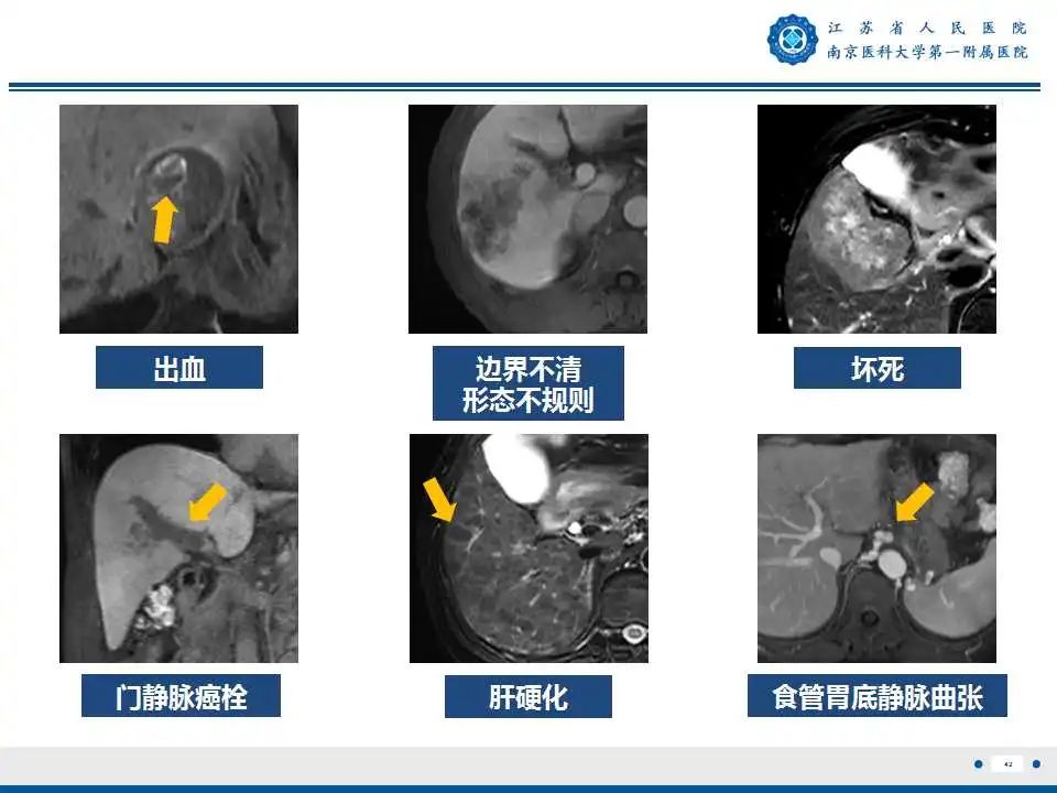【PPT】肝细胞癌—肝脏肿瘤术前MR评估-43