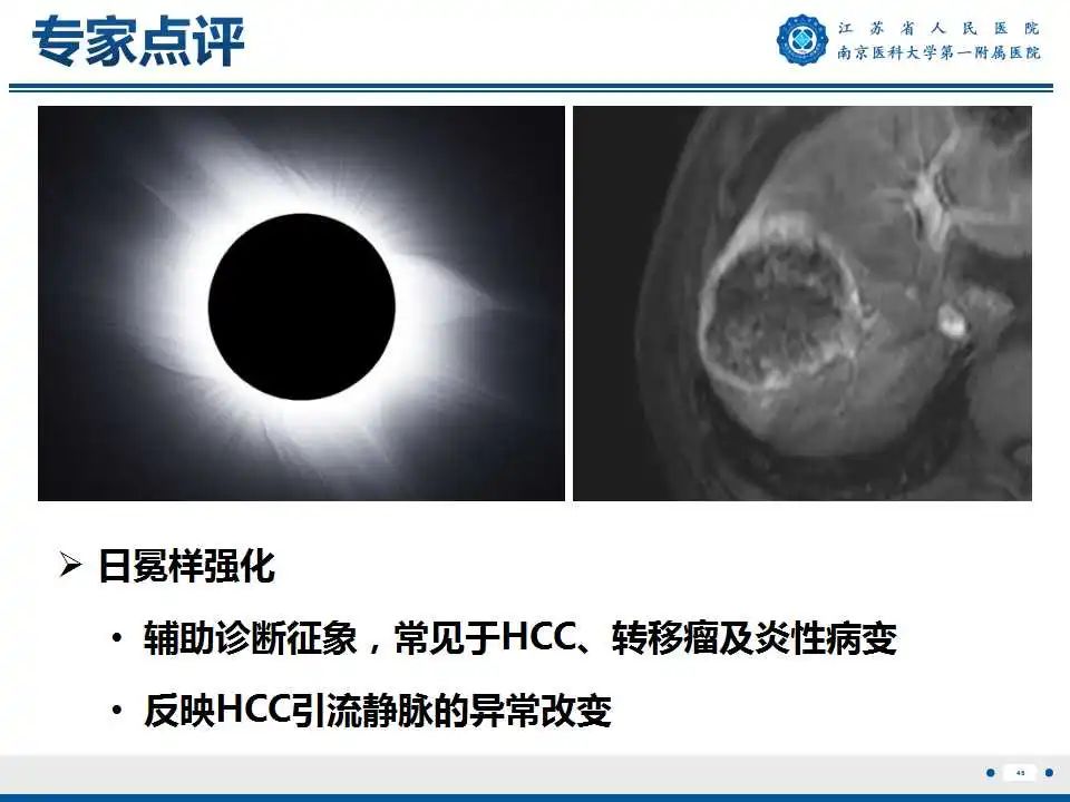 【PPT】肝细胞癌—肝脏肿瘤术前MR评估-47