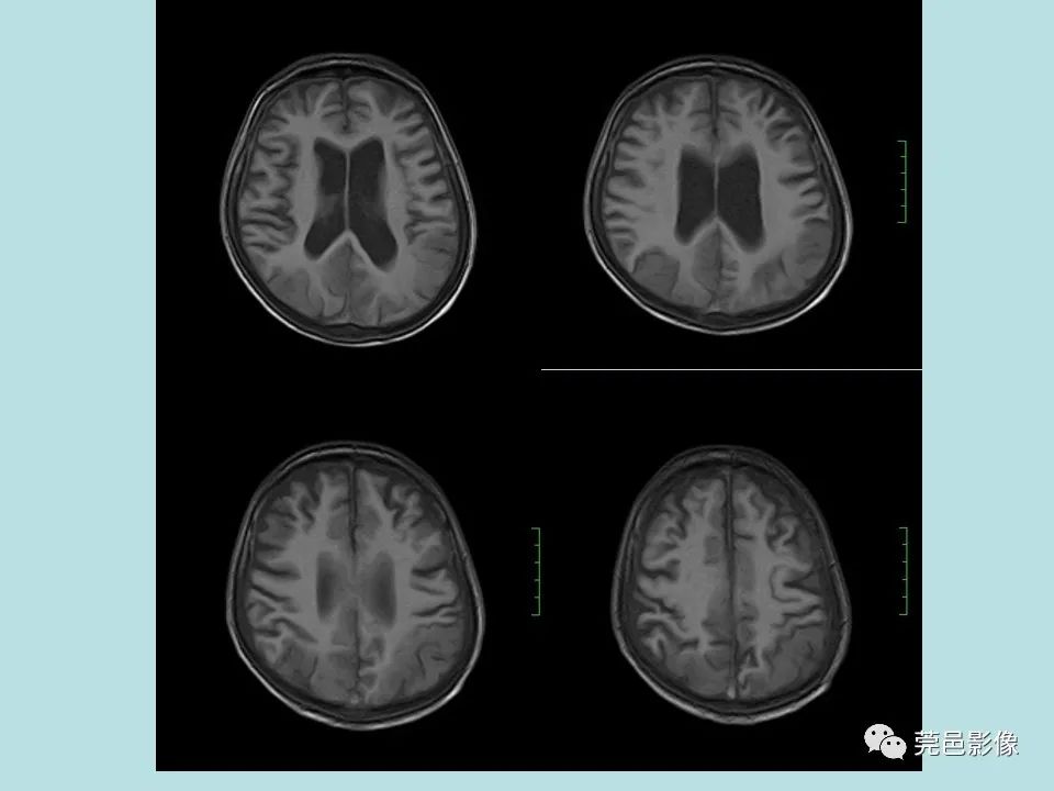 【病例】线粒体脑肌病1例CT及MR-6