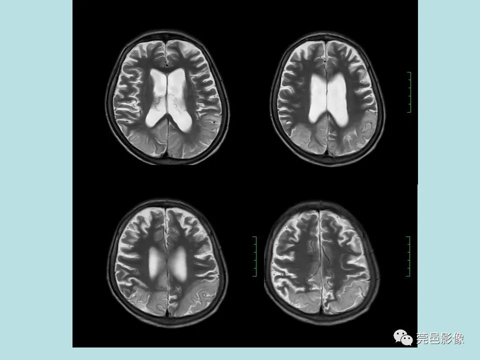 【病例】线粒体脑肌病1例CT及MR-7