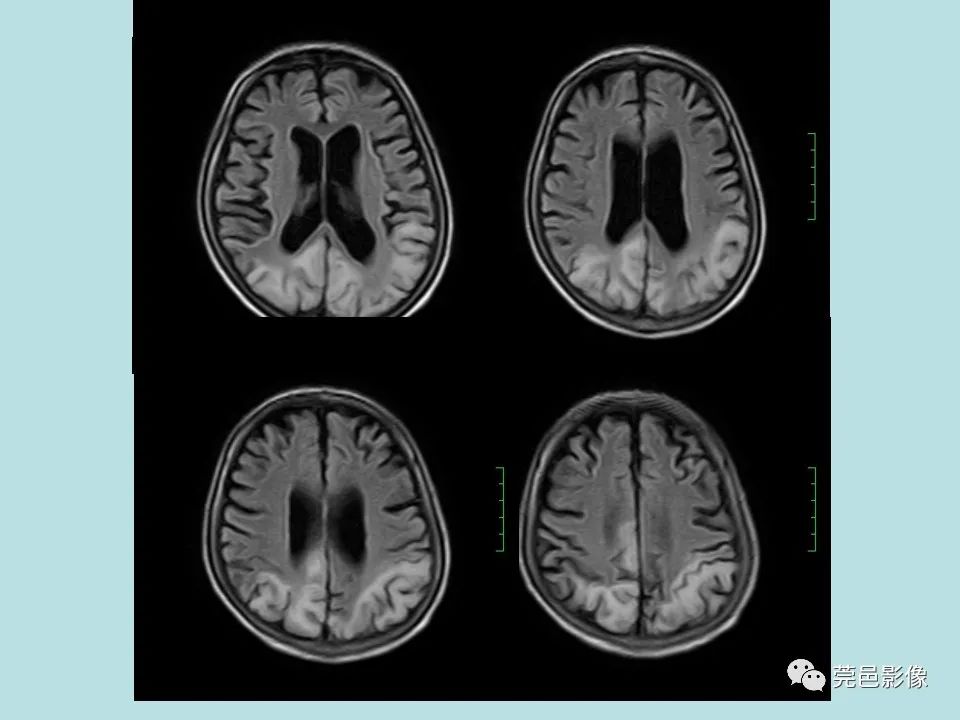 【病例】线粒体脑肌病1例CT及MR-8
