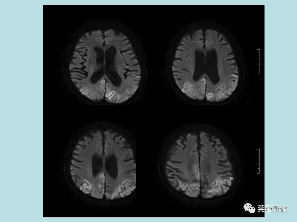 【病例】线粒体脑肌病1例CT及MR-9