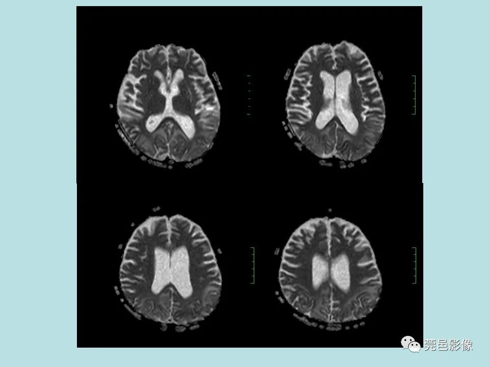 【病例】线粒体脑肌病1例CT及MR-10