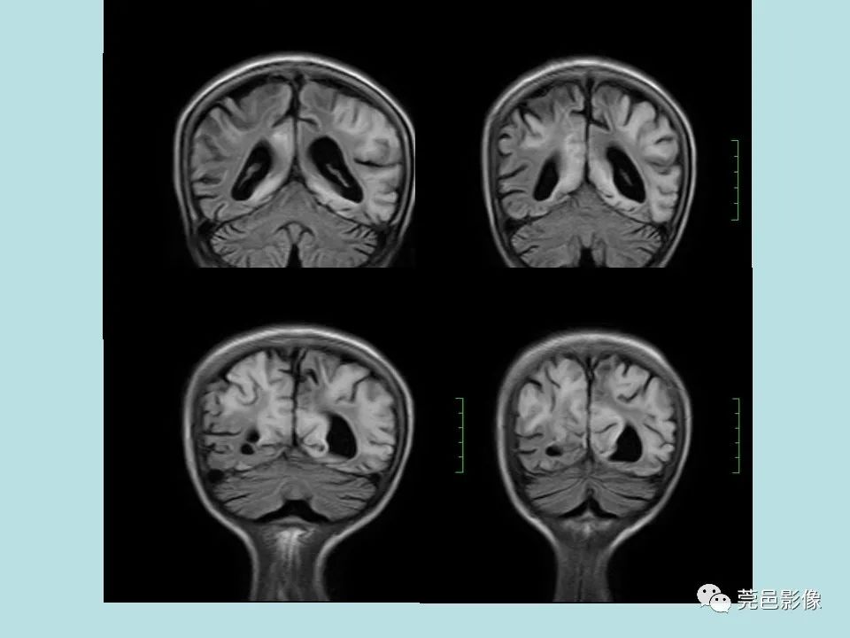 【病例】线粒体脑肌病1例CT及MR-11