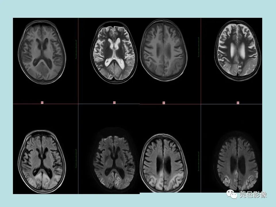 【病例】线粒体脑肌病1例CT及MR-12