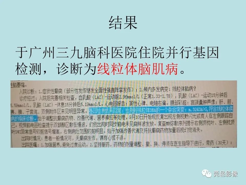 【病例】线粒体脑肌病1例CT及MR-18