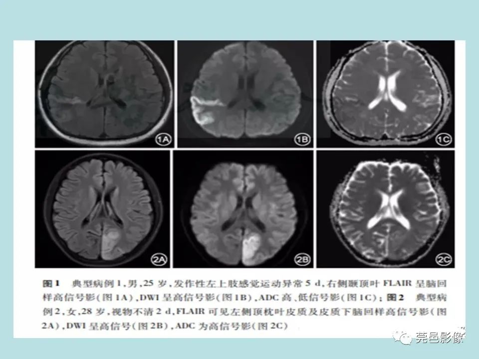 【病例】线粒体脑肌病1例CT及MR-25