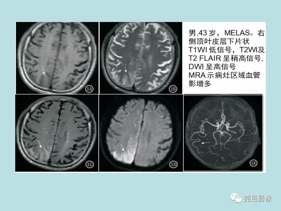 【病例】线粒体脑肌病1例CT及MR-26