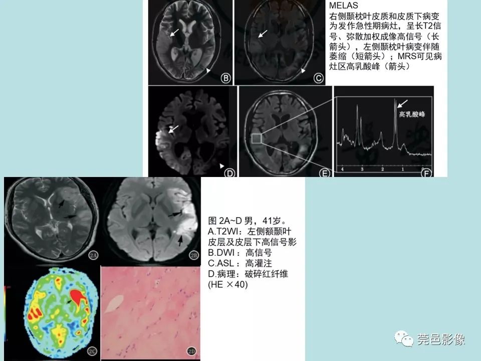 【病例】线粒体脑肌病1例CT及MR-27